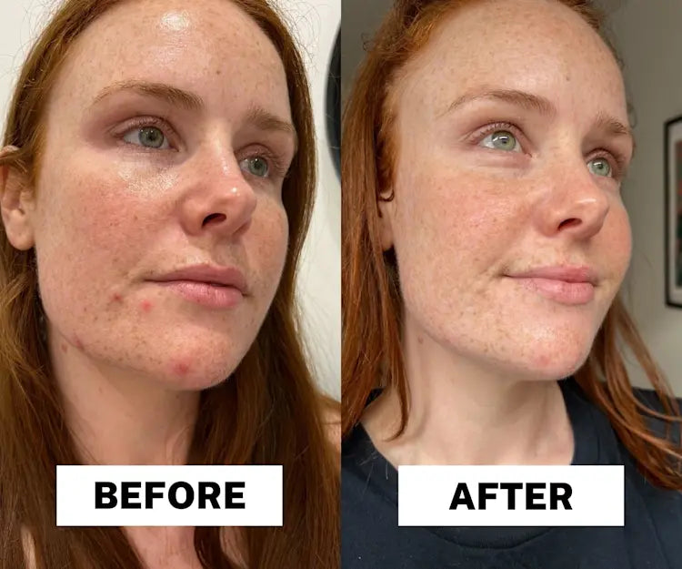 Radiant Glow Duo Peeling Kit™